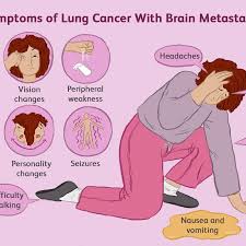 Lung Cancer Spread To The Brain Treatments And Prognosis