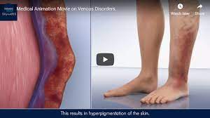 The Beneficial Effects Of Wearing Sigvaris Compression Stockings Vein Specialists Of The Carolinas