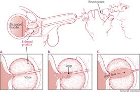 Enlarged Prostate Benign Prostatic Hyperplasia Harvard Health