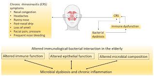 Image result for Rhinosinusitis