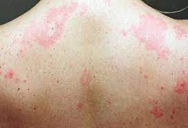 How Do You Get Rid Of Hives Fast