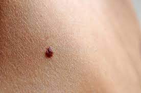 Checking for skin cancer symptoms. 233 Skin Cancer Child Photos Free Royalty Free Stock Photos From Dreamstime