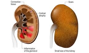 What causes renal cystic disease? Chronic Kidney Failure Symptoms Causes Diagnosis Health Plus