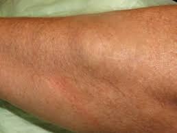 Dercum Disease Dermnet Nz