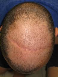However, a deficiency is rare. Avoid Hair Loss With Biotin Harcourt Health