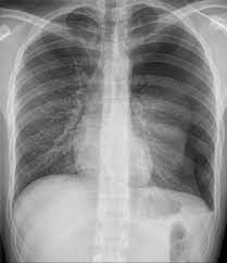 British thoracic society pleural disease guideline 2010. Pneumothorax Sicher Diagnostizieren Und Therapieren