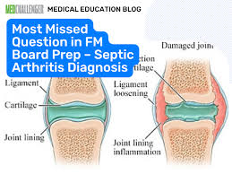 Image result for Septic Joint