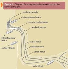 Regional Anesthesia Westchester Hand Surgery Brooklyn New York