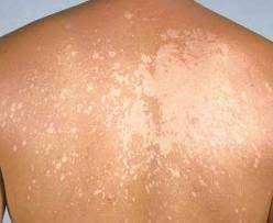 The correct interpretation depends greatly on the field of medicine in which you. Klinik Avicenna Panau Tinea Versicolor Panau Ataupun Facebook