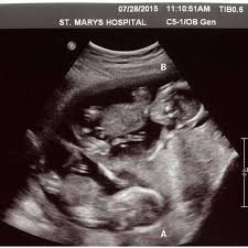 Auch das geschlecht des babys lässt sich beim ultraschall nach wie vor nicht klar erkennen. á… 15 Ssw Schwangerschaftswoche Alle Infos Grosse Entwicklung