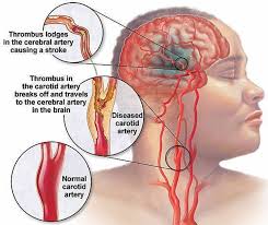 If an abnormal sound, called a bruit listening for a bruit in the neck is a simple, safe, and inexpensive way to screen for stenosis. Carotid Artery Disease Stenosis Carotid Artery Dissection