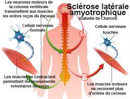 C'est avec pour objectif de collecter des fonds pour la recherche sur cette maladie que le ice bucket challenge, le défi qui. Sclerose Laterale Amyotrophique Maladie De Charcot Symptomes Traitement Definition Docteurclic Com