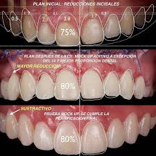 Perfect Dental Work By Ddsgerardochacon The Science Ask How The Art Ask Why Para La Ciencia Solo Hay Evidencia Dental Art Dental Ceramics Dentistry Design