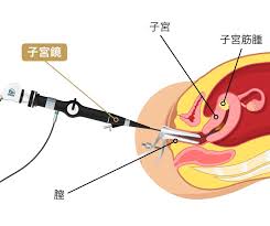 子宮穿孔 / 子宫穿孔 ― zǐgōng chuānkǒng ― uterine perforation. å­å®®ç­‹è…« ä¸»ãªå©¦äººç§'ç–¾æ‚£ åŒ»ç™‚æ³•äººç¤¾å›£å¯¦ç†ä¼š æ±äº¬å›½éš›å¤§å €ç—…é™¢