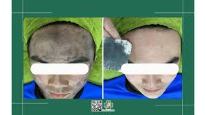Sự thật về hút chì da mặt để thải độc cho da mặt