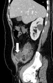 Le cancer colorectal arrive au 3e rang des cancers les plus courants au canada, autant chez les hommes que chez les femmes. Apport Du Scanner Dans La Pathologie Du Carrefour Ileo Caecal Sciencedirect