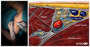 Image result for Axillary Nerve Block