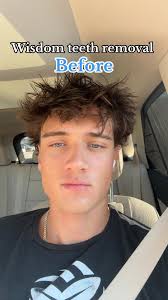 Wisdom Teeth Removal: Before and After Face Changes
