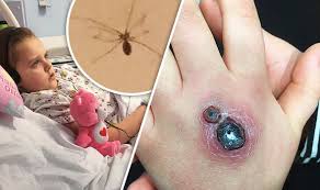 Check spelling or type a new query. Little Girl Hospitalised With Hole In Her Hand After Being Bitten By Spider Nature News Express Co Uk