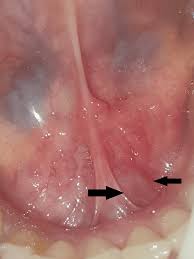 Image result for Sialolithiasis
