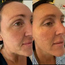 🌿Polynucleotides (Salmon Sperm Facial) results from 1 session. 3-4  sessions advised. Benefits include improved hydration, elasticity, and  texture, as well as reduced wrinkles and inflammation. They stimulate  collagen and elastin production, leading