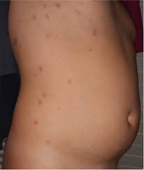 Persistent, prolonged high fever (4 days or more) lethargy skin rash or discoloration (pale, patchy or blue skin) red eyes, lips and tongue swollen hands and feet no appetite, difficulty feeding in. A Review Of The Dermatological Manifestations Of Coronavirus Disease 2019 Covid 19