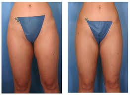 Image result for Liposuction