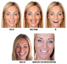 Discover the Evolution of Smile Design Techniques: A Comprehensive…