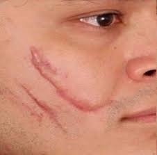 Cara menghilangkan jerawat dengan cara alami dengan konsisten melakukan hal simpel, dijamin cepat dan efektif. Atasi Jaringan Parut Pada Wajah Dengan 5 Pengobatan Alami