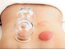 See full list on acucure.ca Cost Cons All You Need To Know About Cupping Therapy The Economic Times