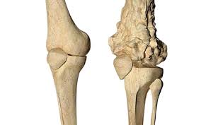 Image result for Osteosarcoma