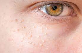 Does Your Skin Have Tiny White Bumps Leave Them Alone Health Essentials From Cleveland Clinic