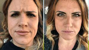 Maybe you would like to learn more about one of these? Before And After Of My First Botox Experience Modern Day Moguls