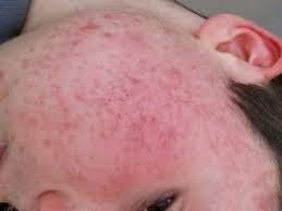 Hausmittel gegen narben entfernen, bleichen und pflegen sie im gesicht und am körper. Pickelmale Entfernen Hautarzt Pickelmale Entfernen Was Hilft Gegen Die Dunklen Flecken Nivea Wimpernkranzverdichtung Oben Unten Joli 5 Tipps Gegen Pickel Pickelmale So Wirst Du Sie Schnell Los Hautausschlag Oder Sind Das