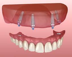 How much does it cost to have a dental implant? Cost Of Dental Implants In West Seneca Ny I Missing Teeth Applegate Dental Pllc