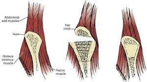 Pain in iliac crest may also arise due to gluteus medius pain. Techniques And Complications Of Bone Graft Harvesting Musculoskeletal Key
