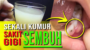 Obat sakit gigi berlubang dengan bahan alami. Ajaib Obat Sakit Gigi Berlubang Paling Ampuh Cukup Sekali Kumur Terbukti Kesehatan Youtube