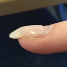 Und gibt es irgendetwas, was man danach nicht lieber machen sollte, damit sie sich nicht verfärben oder so? Rillen Am Gelnagel Eingewachsen Gelnagel