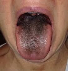 Image result for black tongue symptoms