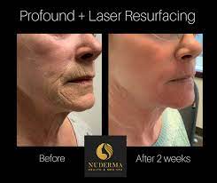 Maybe you would like to learn more about one of these? Nuderma Health Med Spa Beitrage Facebook