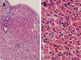 Russell bodies — globular plasma cell inclusions, mucoprotein in nature, containing surface gamma globulin, and representing aggregates of immunoglobulins synthesized by the cell. A Case Of Mucosa Associated Lymphoid Tissue Lymphoma Of The Gastrointestinal Tract Showing Extensive Plasma Cell Differentiation With Prominent Russell Bodies