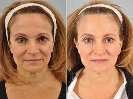 Plastic surgery group, botox before and after photos (albany, ny). Botox Before And After Photos Philadelphia