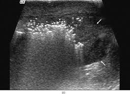 Save a life by knowing the signs and the most effective interventions. Fournier S Gangrene Us And Mr Imaging Findings Sciencedirect