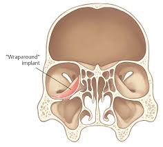 We did not find results for: 32 Medial Orbital Blowout Fracture Repair Ento Key