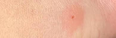 Ein zeckenbiss muss nicht immer von einem arzt gesehen und behandelt werden. Borreliose Lyme Desease Springermedizin De