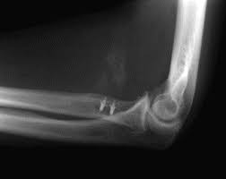 Bizepssehnenriss Ruptur Der Distalen Bicepssehne Sportklinik Ravensburg