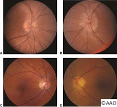 Anterior synechia) or lens (i.e. Foster Kennedy Vs Pseudo Foster Kennedy Eyewiki