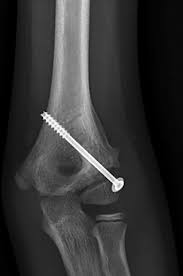 Image result for Lateral Condyle Fracture