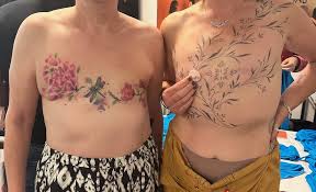 Image result for Mastectomy