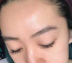 Check spelling or type a new query. Incredible Before And After Images Show How One Woman Rid Her Skin Of Fungal Acne Daily Mail Online
